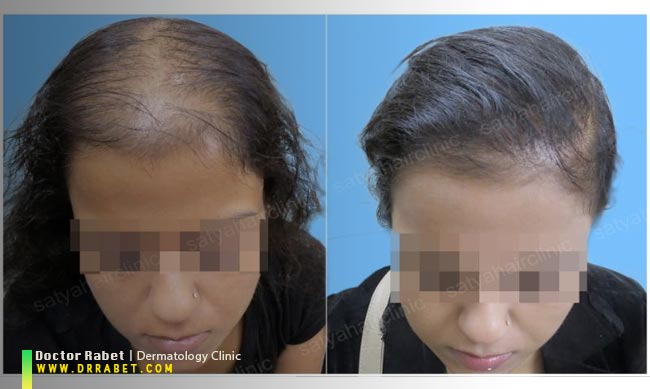 عکس قبل و بعد کاشت موی مصنوعی