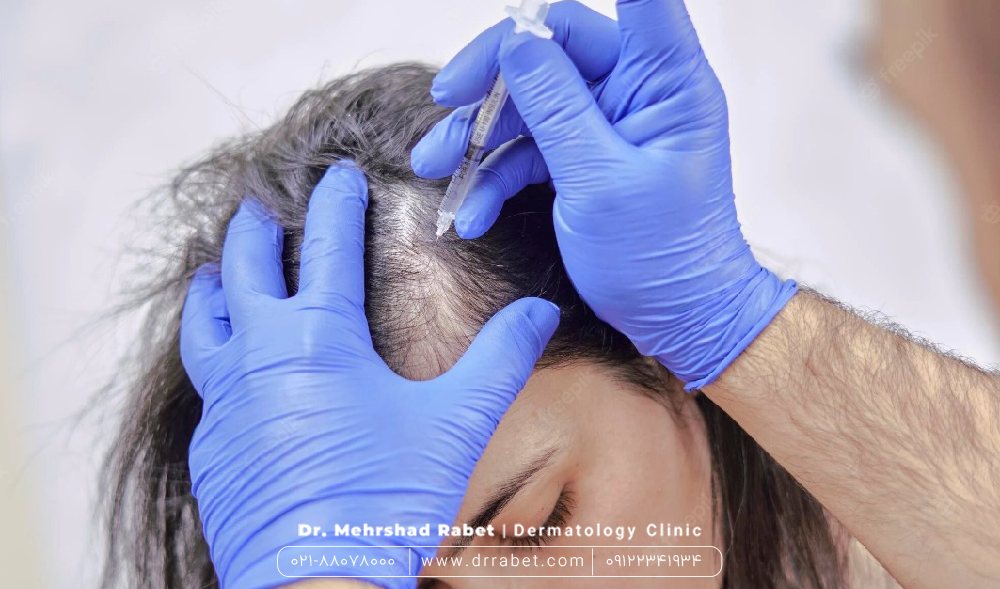 راه های درمان ریزش موی ارثی یا ژنتیک