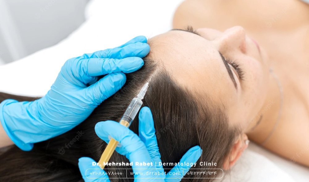 مزوتراپی، جدیدترین درمان ریزش مو ارثی