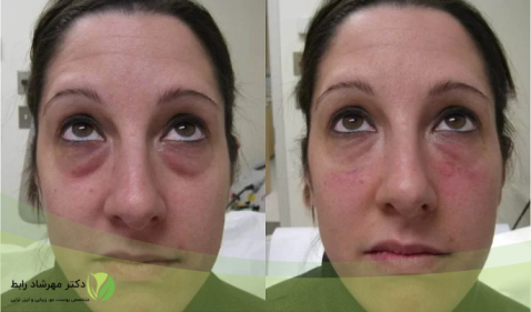 راه های پیشگیری از عوارض ژل 