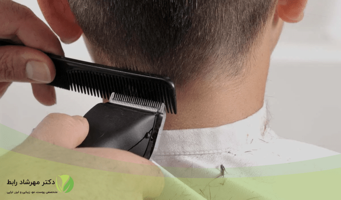 اصلاح سر بعد از کاشت مو