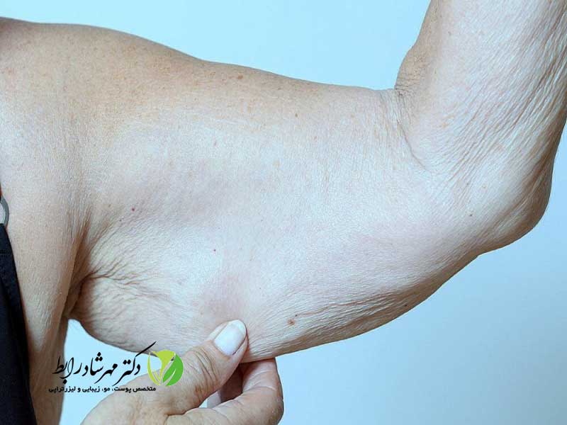 علایم-سلولیت-بازو