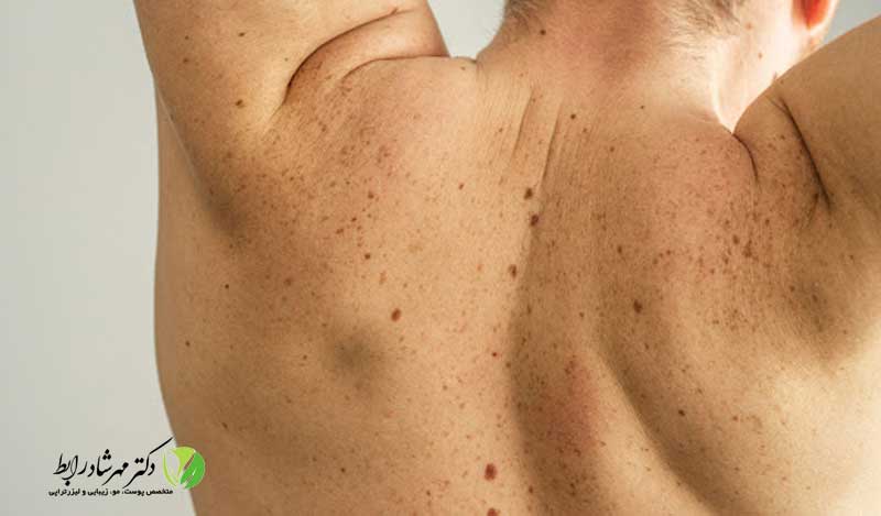 لکه-های-قهوه-ای-روی-کمر