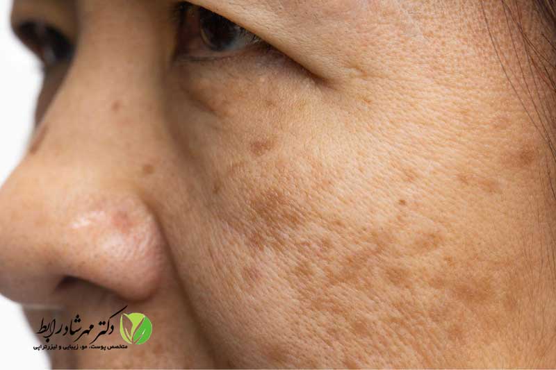 لکه-های-قهوه-ای-ناشی-از-آفتاب-سوختگی