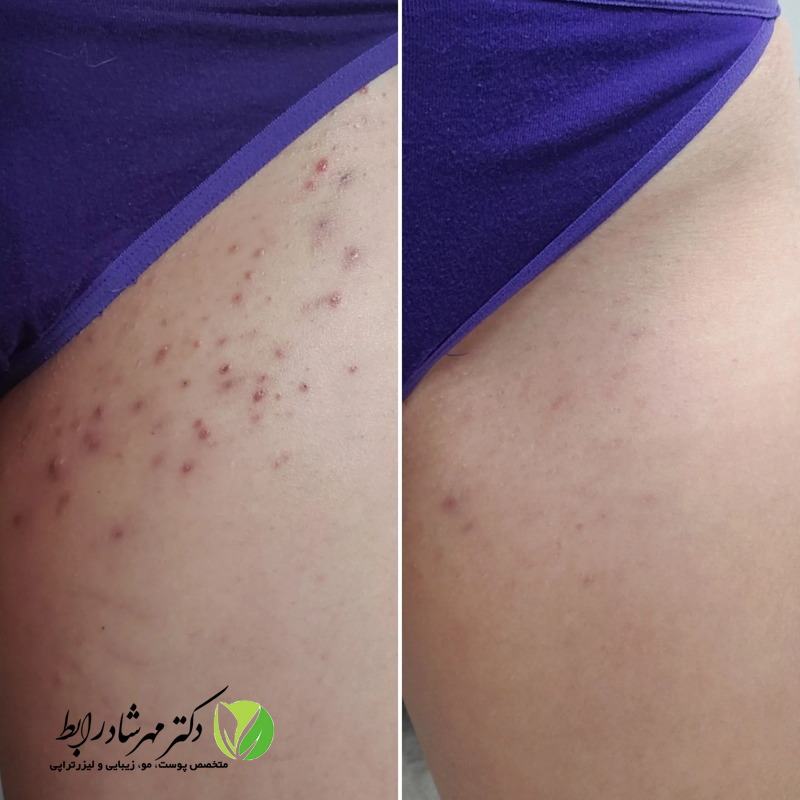 رفع تیرگی کشاله ران