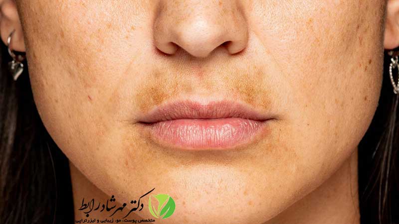 لک-ملاسما-چیست