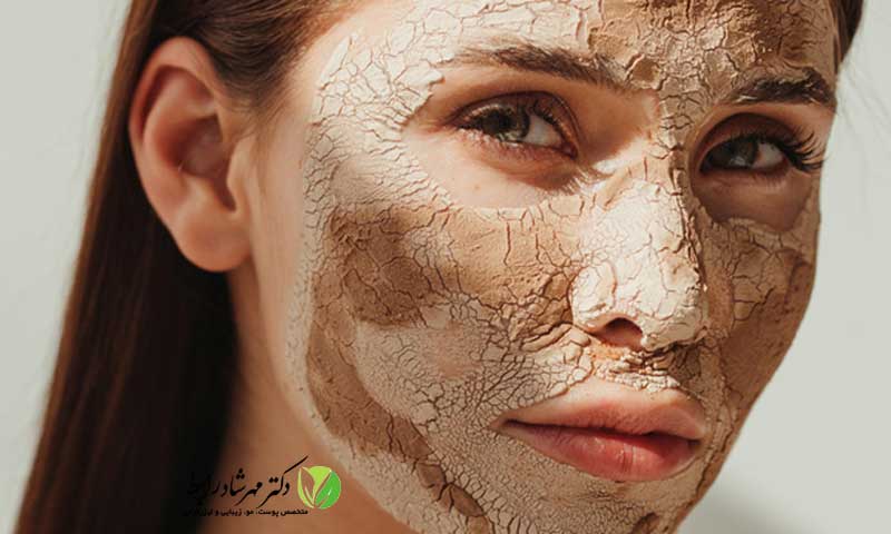 ماسک-برای-منافذ-باز-پوست-صورت