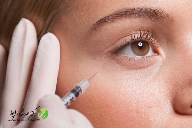 تزریق-مزوژل-برای-تیرگی-زیر-چشم