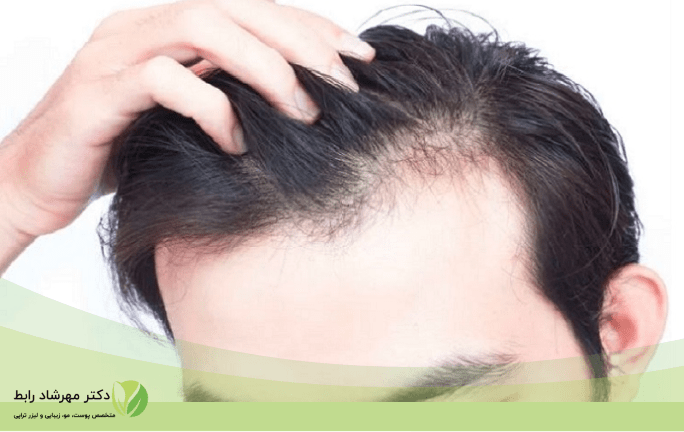 نازک شدن مو ارثی