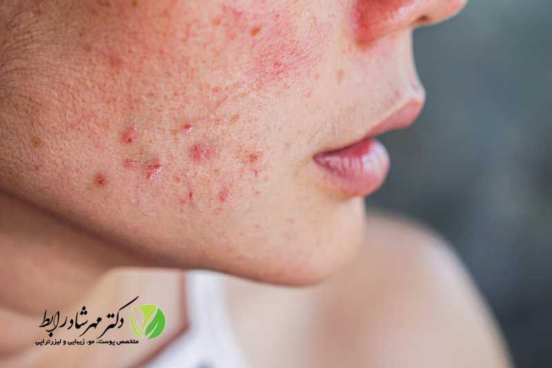 لیزر-پوست-و-راکوتان---تصویر-شاخص