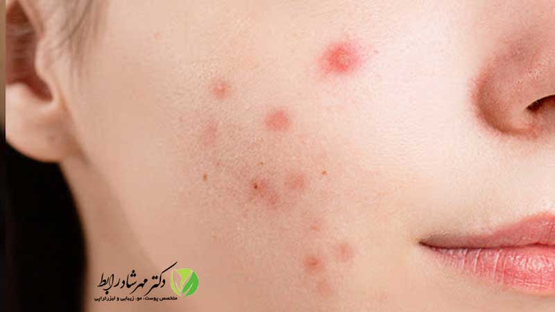 لکه-قرمز-بدون-خارش-ناشی-از-جوش