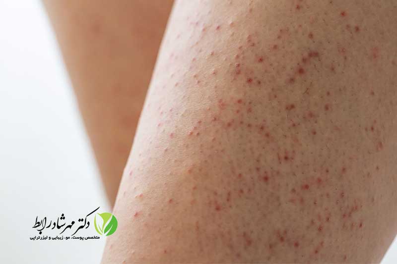 لکه-قرمز-بدون-خارش-ناشی-از-کراتوزپیلاریس