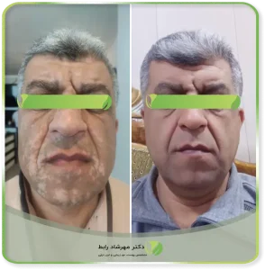 عکس قبل و بعد بیماری پیسی