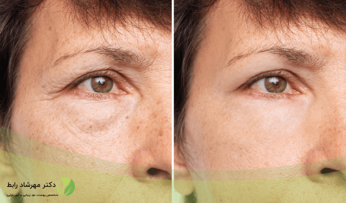 پروفایلو بهتره یا جالپرو؟