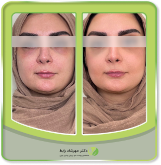 قبل و بعد تزریق فیلر زیرچشم