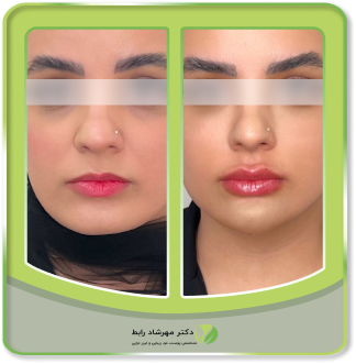 عکس-قبل-بعد-فیلر-لب