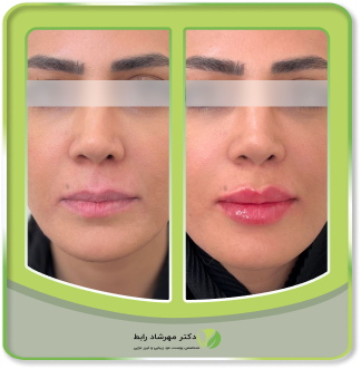 عکس-قبل-بعد-فیلر-لب