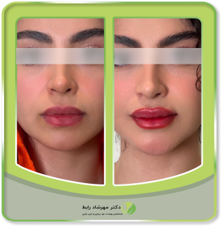 عکس-قبل-بعد-فیلر-لب